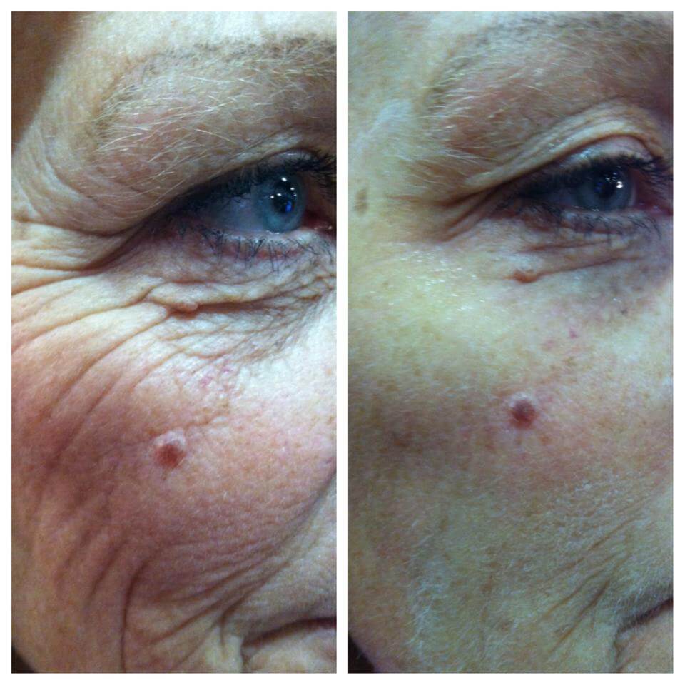 Wrinkle Release Syringe - Non-Surgical Rejuvenating Lift - Image 3