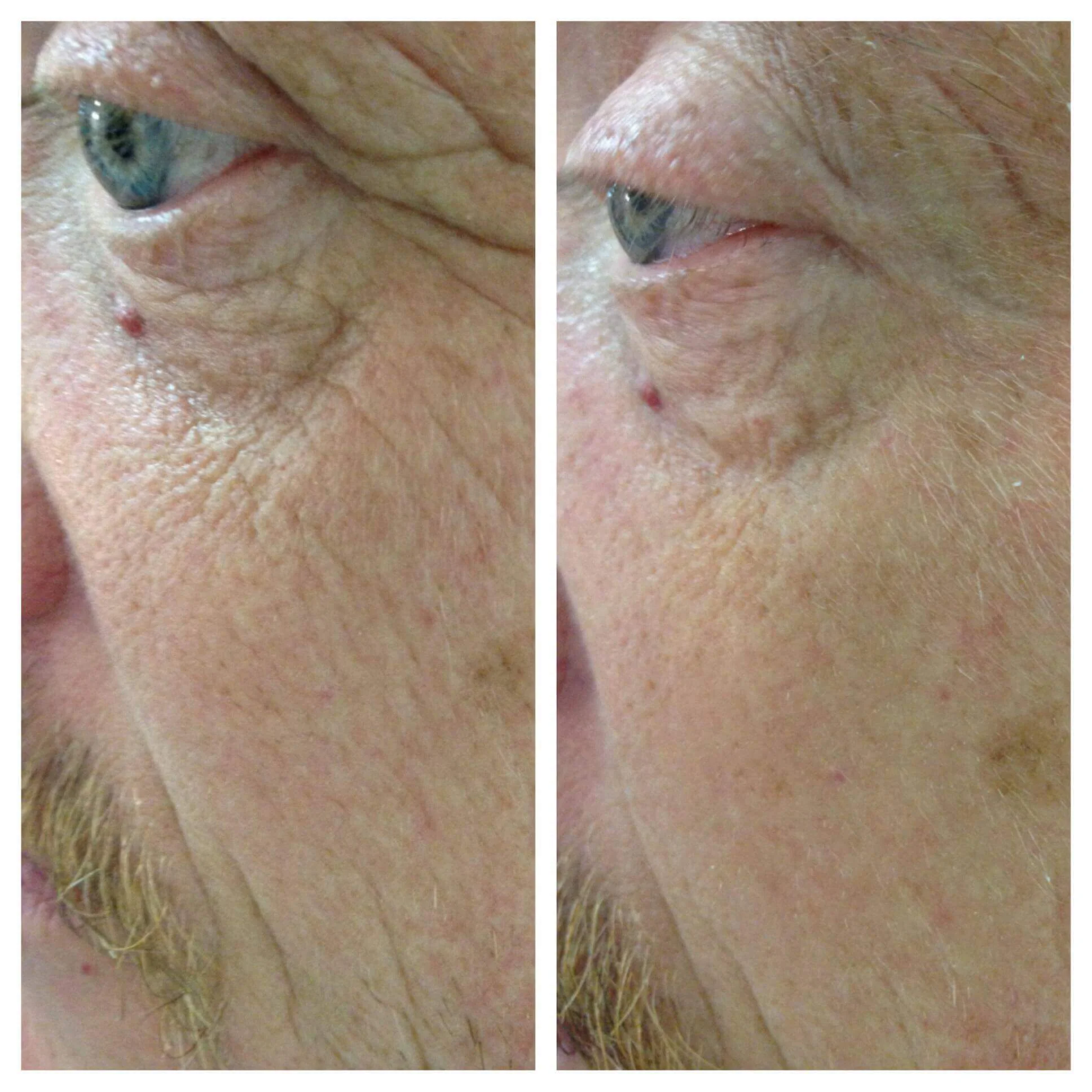 Wrinkle Release Syringe - Non-Surgical Rejuvenating Lift - Image 4